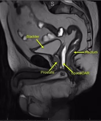 SBRT Compresses Prostate Cancer Treatment 1 web