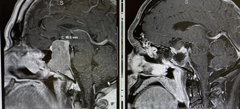 Endoscopic Brain Surgery 2 web