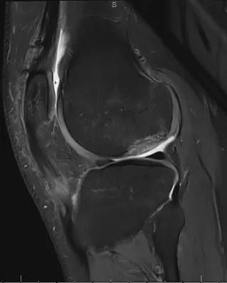 MRI Post-Op