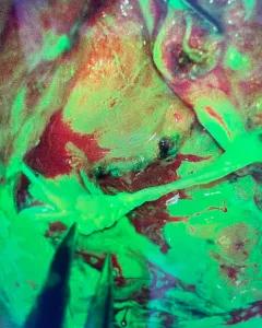 Microsurgeons Improve Sensory Recovery in Breast Cancer Patients 3