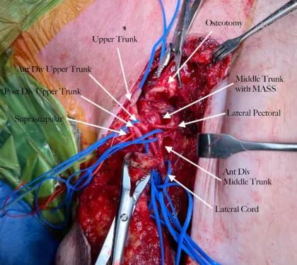 Brachial Plexus Injuries 2 web