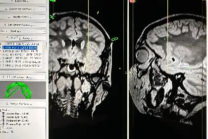 APH Refractory Epilepsy 1 web