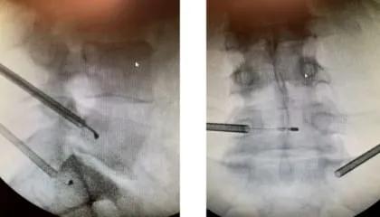 Novel Basivertebral Nerve 2 web