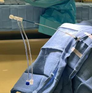 Laser Interstitial Thermal Therapy 2