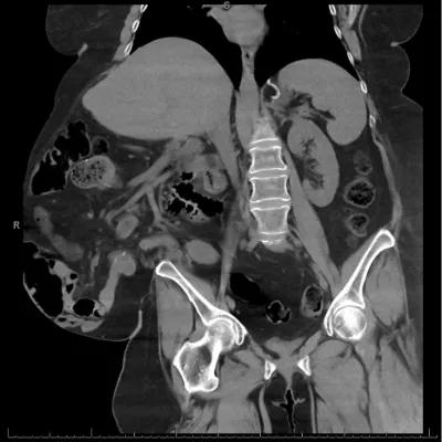 Complex Hernia Center 4