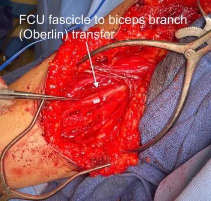 Brachial Plexus Injuries 3 web