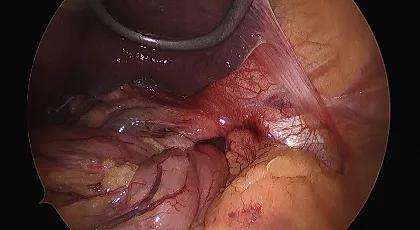Foregut Surgery 2 web