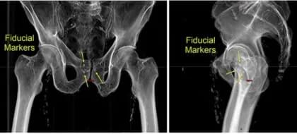 SBRT Compresses Prostate Cancer Treatment 2 web