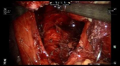 “Foregut