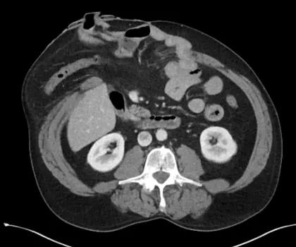 Complex Hernia Center 3