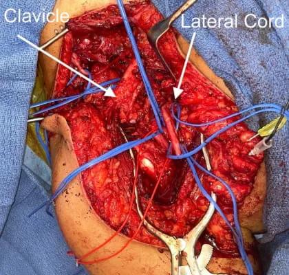 Brachial Plexus Injuries 5 web