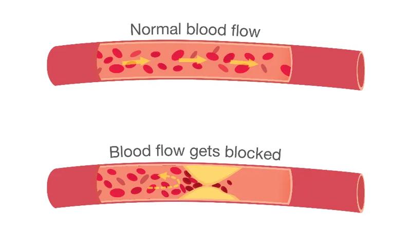 Top artery is healthy. Middle & bottom arteries show plaque formation, rupturing, clotting & blood flow occlusion. 