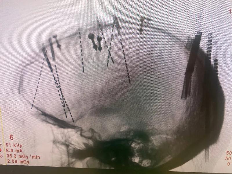 APH Refractory Epilepsy 2 web