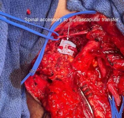Brachial Plexus Injuries 4 web