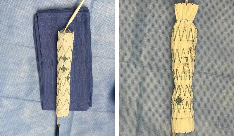 Customized Fenestrated-Branched Endovascular Repairs 1