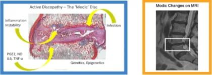 Novel Basivertebral Nerve 3 web