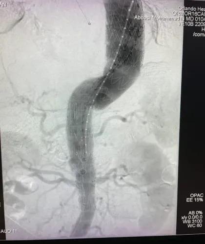 Customized Fenestrated-Branched Endovascular Repairs 3