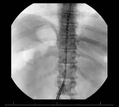 Novel Closed Loop Spinal Cord Stimulator Advances Personalized Pain Management 2
