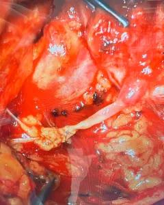 Microsurgeons Improve Sensory Recovery in Breast Cancer Patients 1
