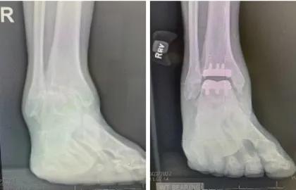 Advanced Ankle Arthroplasty 1 web