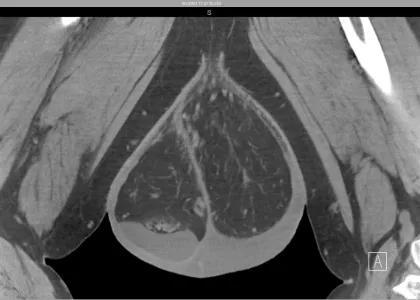 Complex Hernia Center 2