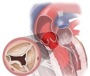 Web Biostable Aortic Insufficiency chart 2 Tile